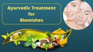 Ayurvedic Treatment for Blemishes 1024x576