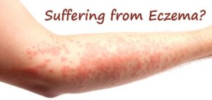 Eczema