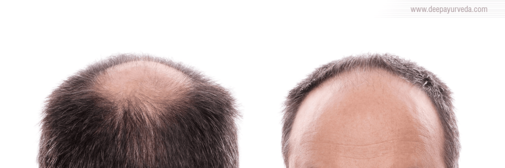 Hair Loss Treatment