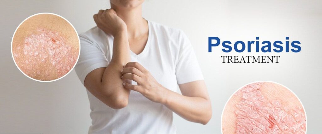 Psoriasis Treatment