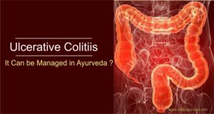 Ulcerative Colitis 2