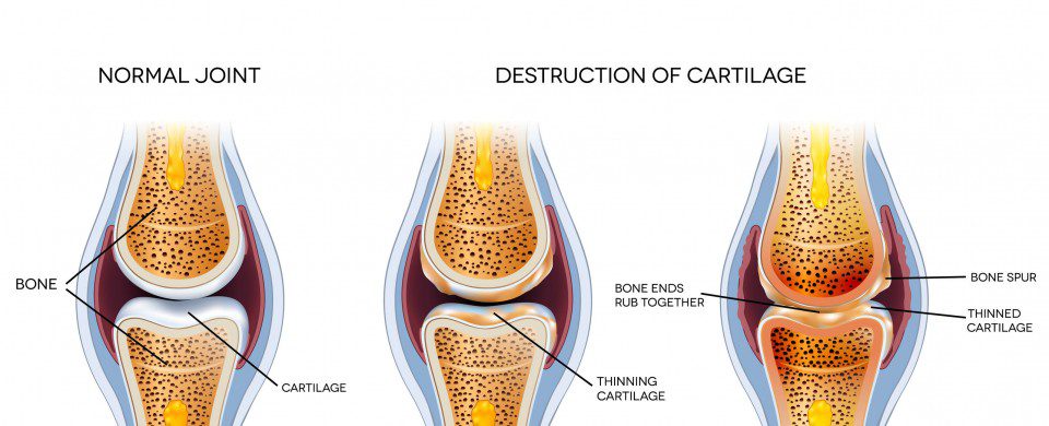 arthritis