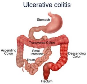 ulcerative colitis 1